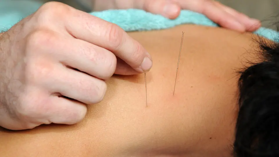 Close view of dry needling being performed as an optional treatment technique.